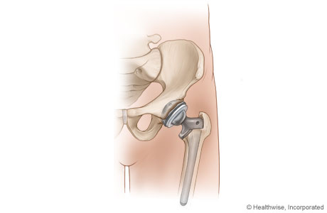 Completed hip replacement Completed hip replacement