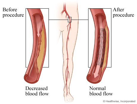 Decreased blood flow before angioplasty and normal blood flow after angioplasty. Decreased blood flow before angioplasty and normal blood flow after angioplasty.