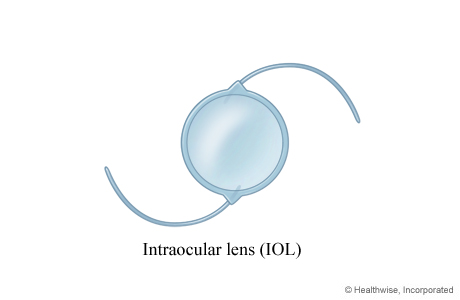 An intraocular lens (IOL) An intraocular lens (IOL)