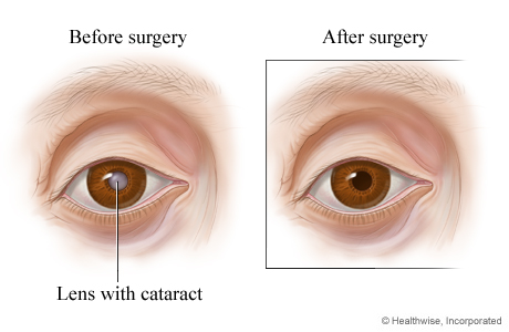 How the eye looks before and after cataract surgery How the eye looks before and after cataract surgery