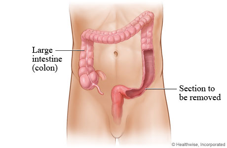 Large intestine (colon). Large intestine (colon).