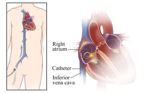 View of catheter from groin to heart, with detail of catheter in the atrium.