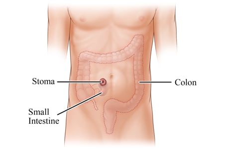 Colon and small intestine, with small intestine attached to stoma