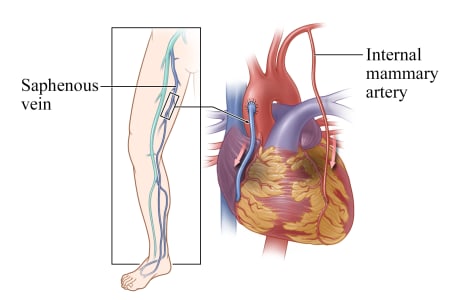 Location of saphenous vein in leg, and heart showing saphenous vein and an internal mammary artery used to bypass the diseased coronary artery.