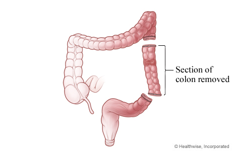Section of colon removed. Section of colon removed.