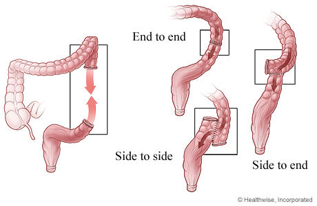 Three ways that colon ends can be reattached after surgery. Three ways that colon ends can be reattached after surgery.