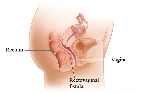 Picture of a rectovaginal fistula