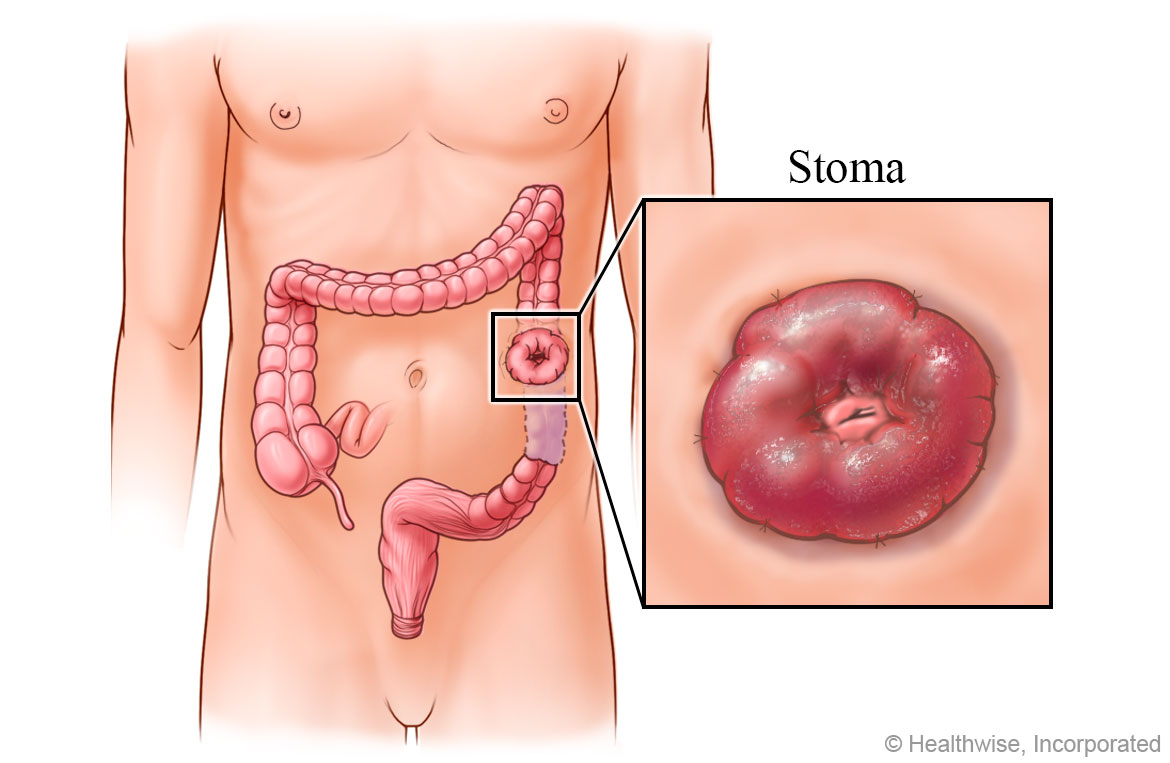 A stoma created after colon surgery. A stoma created after colon surgery.