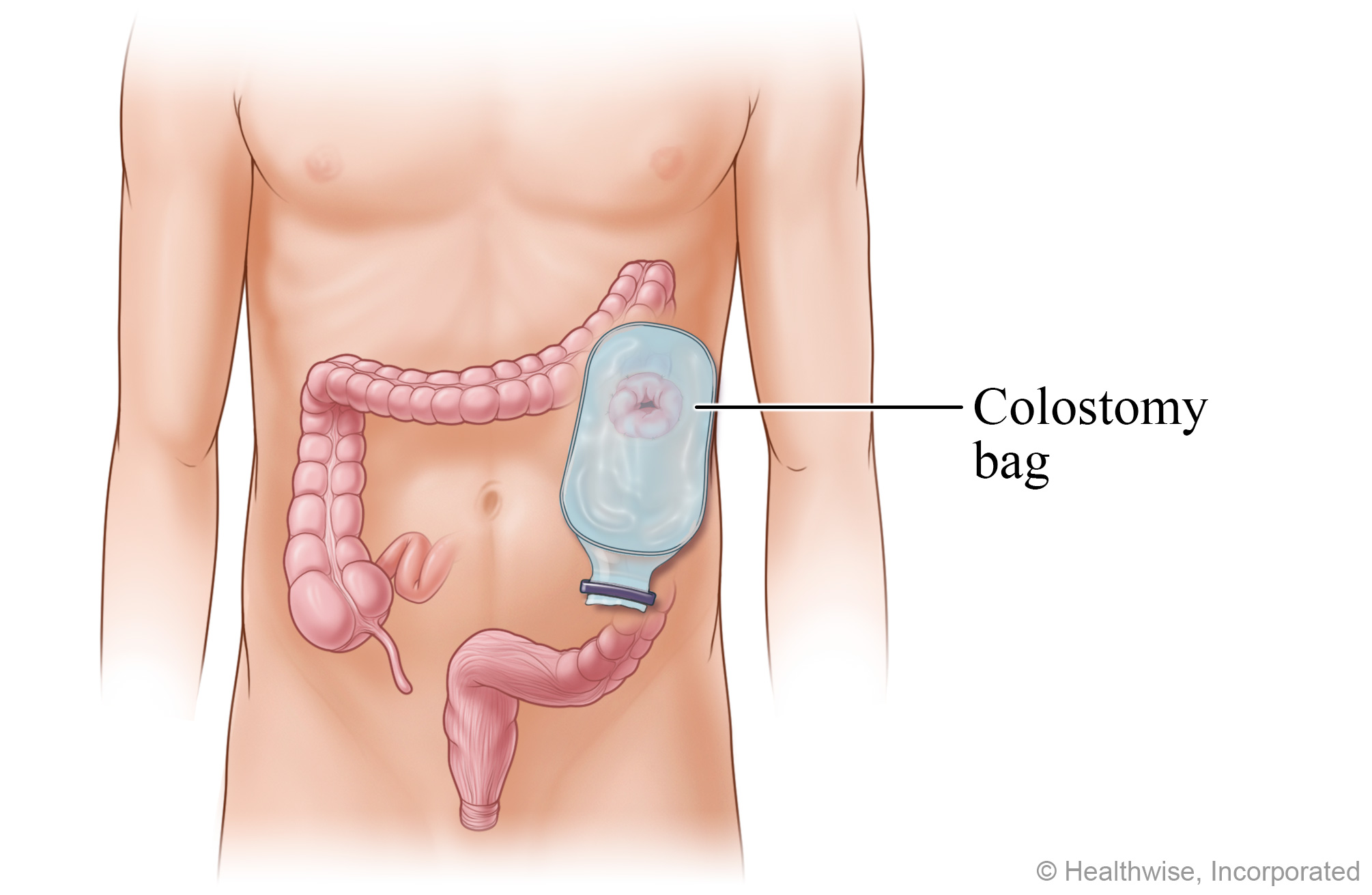 A colostomy bag positioned on the stoma. A colostomy bag positioned on the stoma.