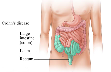 Crohn's disease in part of the digestive tract.