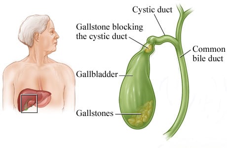 Gallbladder and gallstones