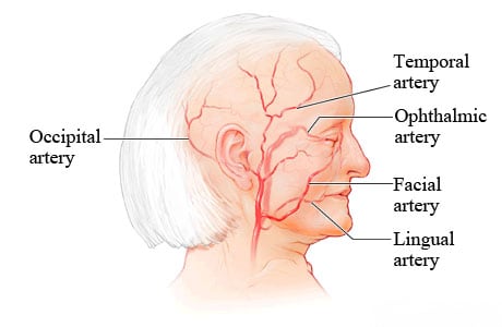 Arteries commonly affected by giant cell arteritis