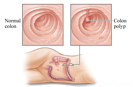 A healthy colon and a colon polyp