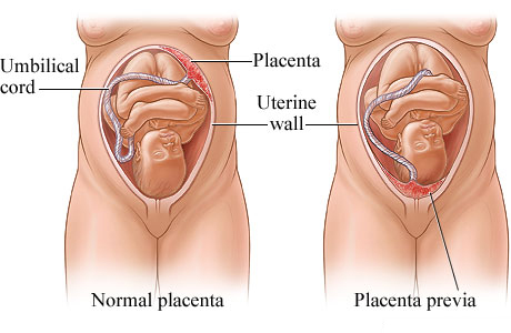 Picture of normal placenta and placenta previa