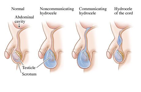 Three types of hydroceles