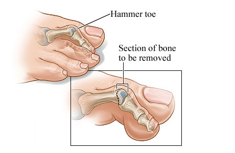 Hammer toe and the section of bone to be removed