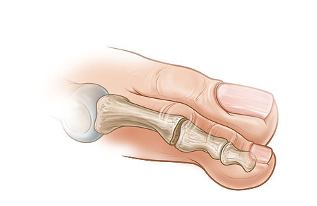 Straightened toe after bone section has been removed
