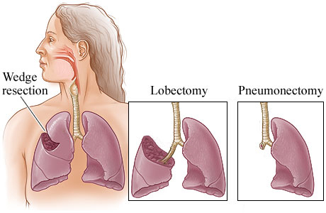 Picture of three types of lung surgery