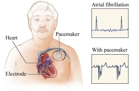 Location of pacemaker in chest.