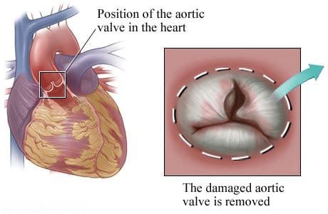 Location of aortic valve in the heart with detail of damaged valve.