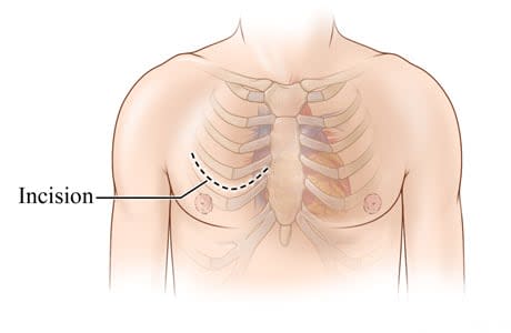 Chest incision site across chest between two ribs.