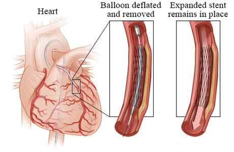 Deflated balloon leaving an expanded stent in place.