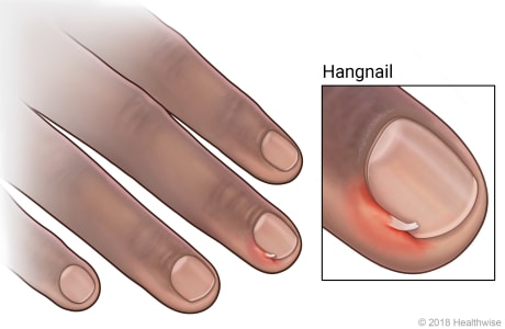 Hangnail