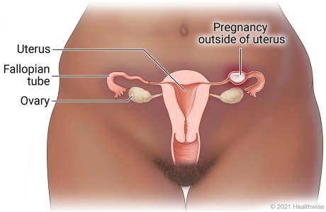Female reproductive organs in pelvic area, including uterus, ovaries, and fallopian tubes, showing pregnancy outside uterus in fallopian tube.