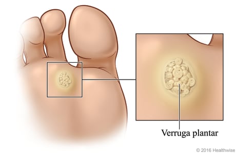 Plantar wart on bottom of foot below toes, with close-up of raised and bumpy wart.
