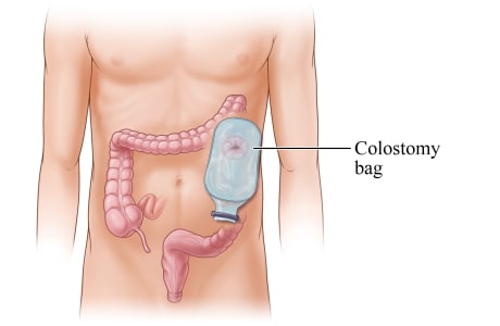 Colostomy pouch