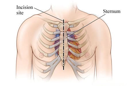 Location of incision in chest