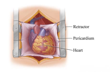 Retractor exposing the heart in the chest