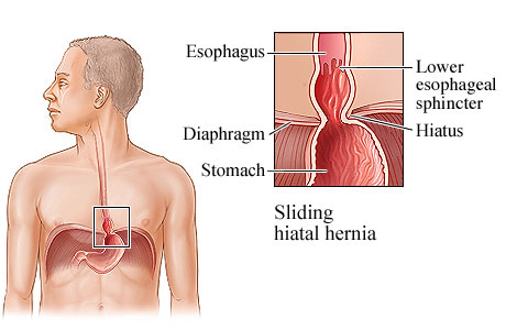 Picture of a sliding hiatal hernia