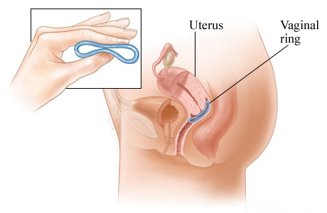 Vaginal ring method of birth control