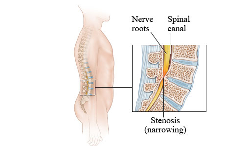 Picture of lumbar spinal stenosis