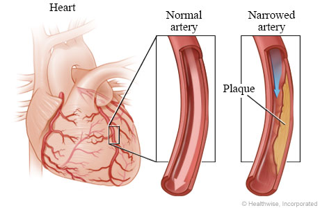 Normal coronary artery and artery narrowed by plaque Normal coronary artery and artery narrowed by plaque