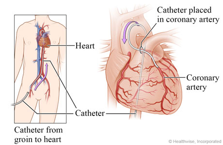 Catheter going from groin to heart, with detail of catheter in a coronary artery Catheter going from groin to heart, with detail of catheter in a coronary artery
