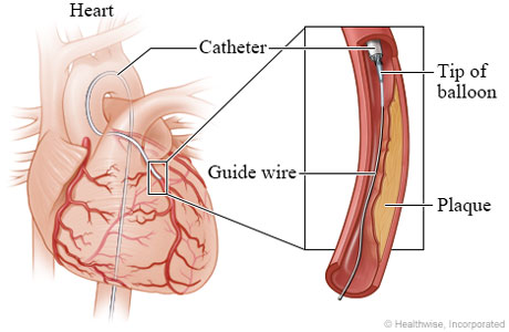 Guide wire and tip of balloon in narrowed artery Guide wire and tip of balloon in narrowed artery
