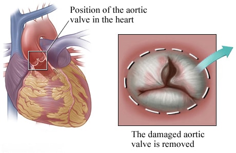 Location of aortic valve in the heart with detail of damaged valve.