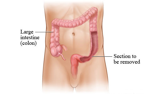 Large intestine (colon).