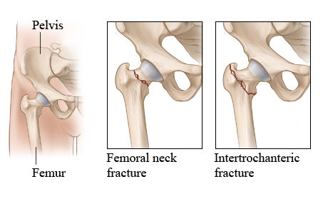 Two types of hip fracture