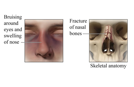 Broken nose