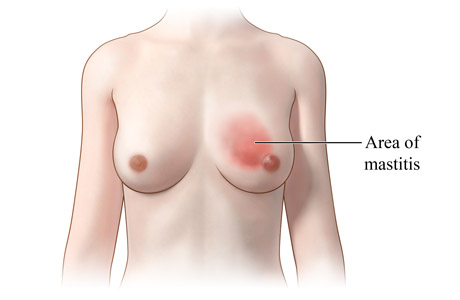Picture of mastitis (inflammation of the breast)