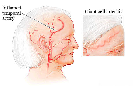 Giant cell arteritis