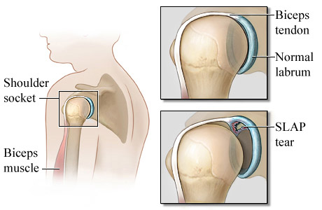 One type of shoulder SLAP tear