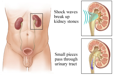 How lithotripsy for kidney stones works