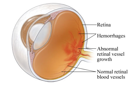Diabetic retinopathy