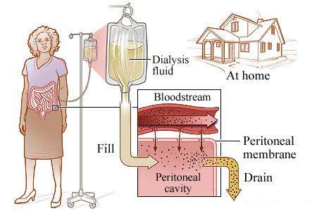 The process of peritoneal dialysis