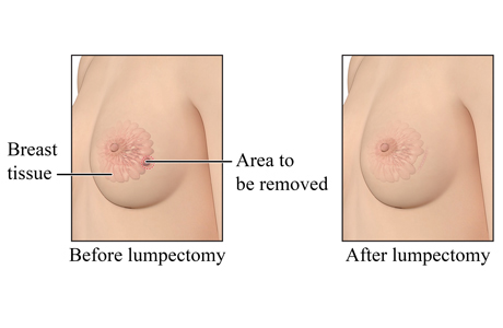 Before and after lumpectomy