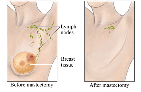 Before and after a mastectomy.